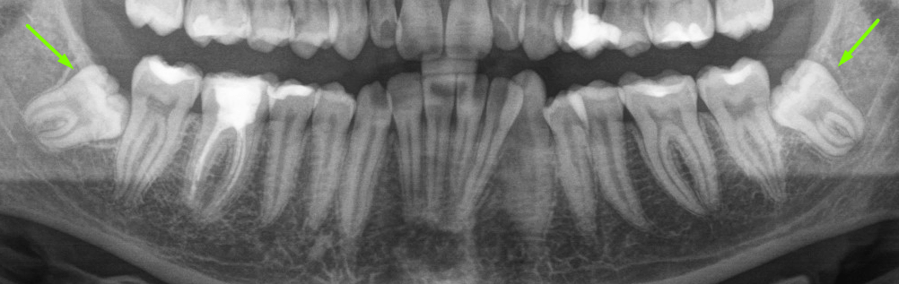Сухая лунка после удаления зуба - симптомы и как лечить