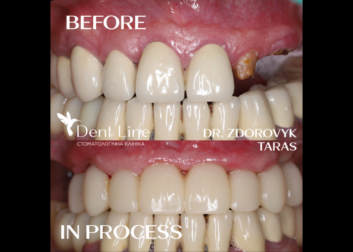 Імплантація за 1 день на верхній щелепі