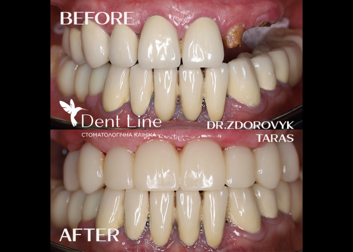 Тотальна трансформація на верхній щелепі