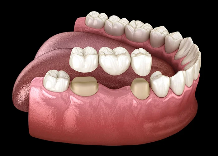 Заміна зубних коронок – як часто та коли їх треба змінювати?