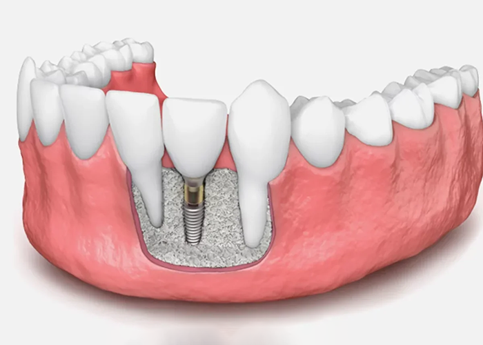 Транссинусальна імплантація – відновлення зубів без нарощування кістки методами All-on-4 та All-on-6