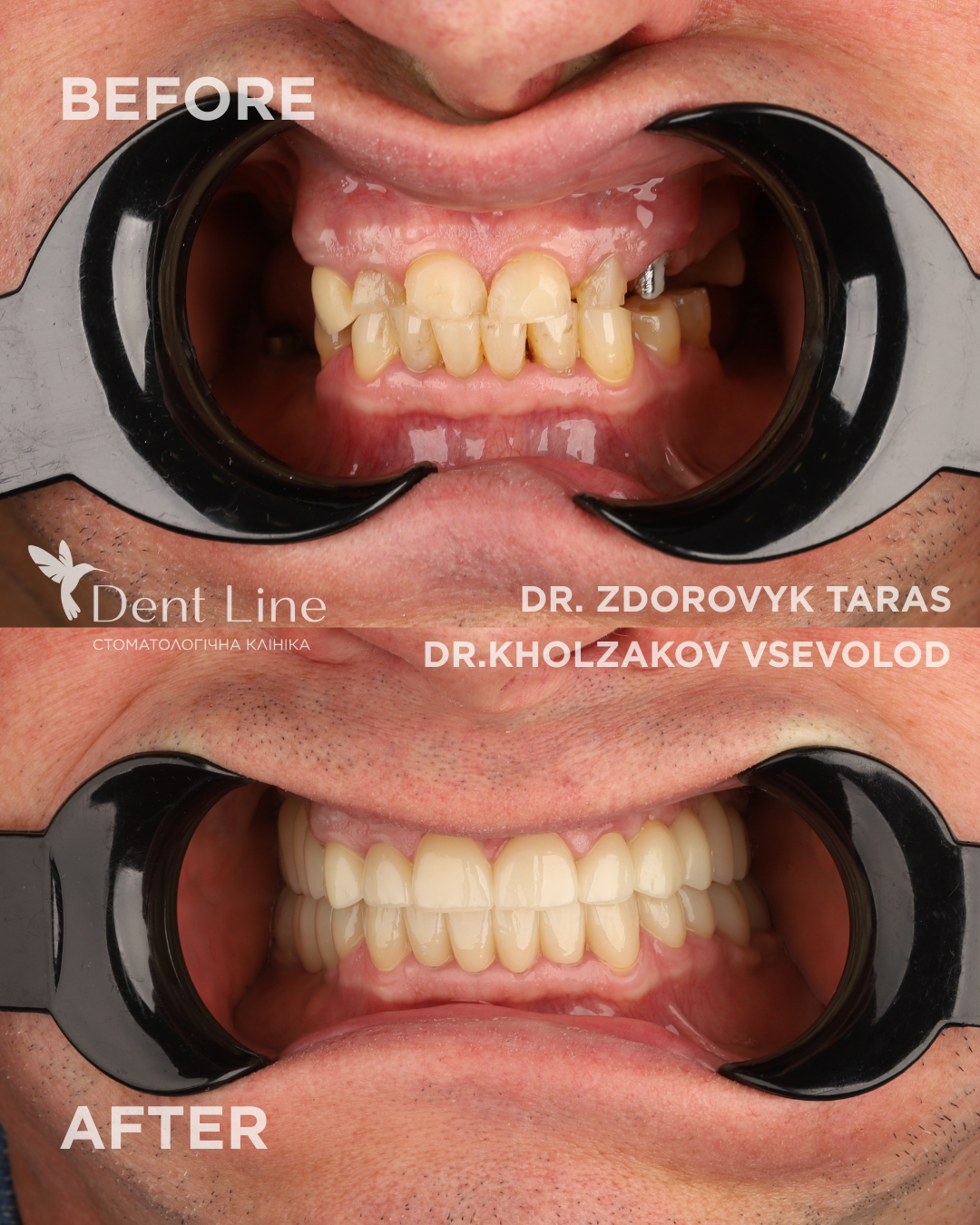 комплексна реабілітація зубів пацієнта фото
