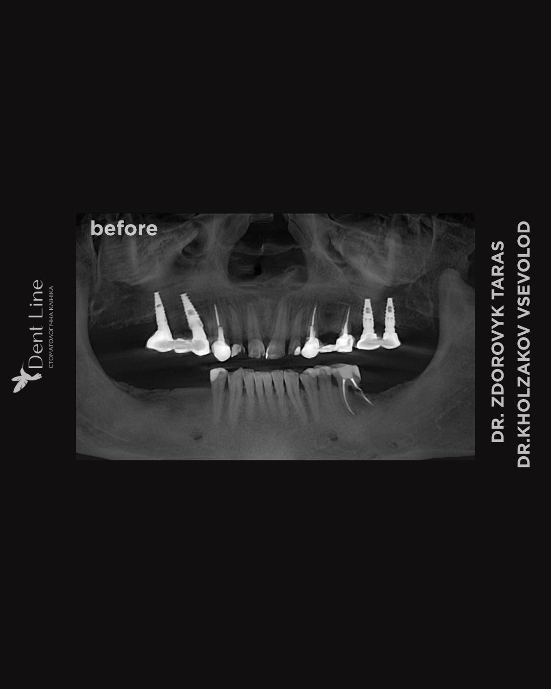 поетапна імплантація до і після