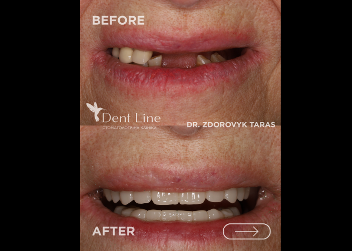 Зуби за 1 день. Методика імплантації зубів All-on-4. Лікар Здоровик Тарас