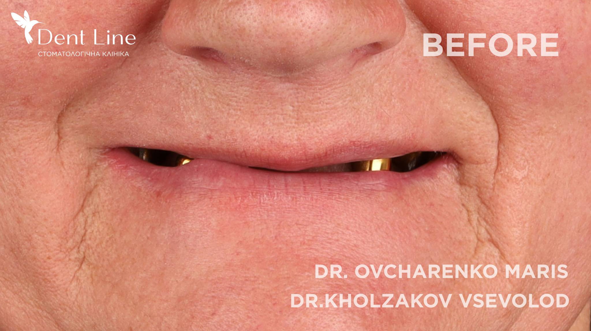 перепротезирование зубов киев