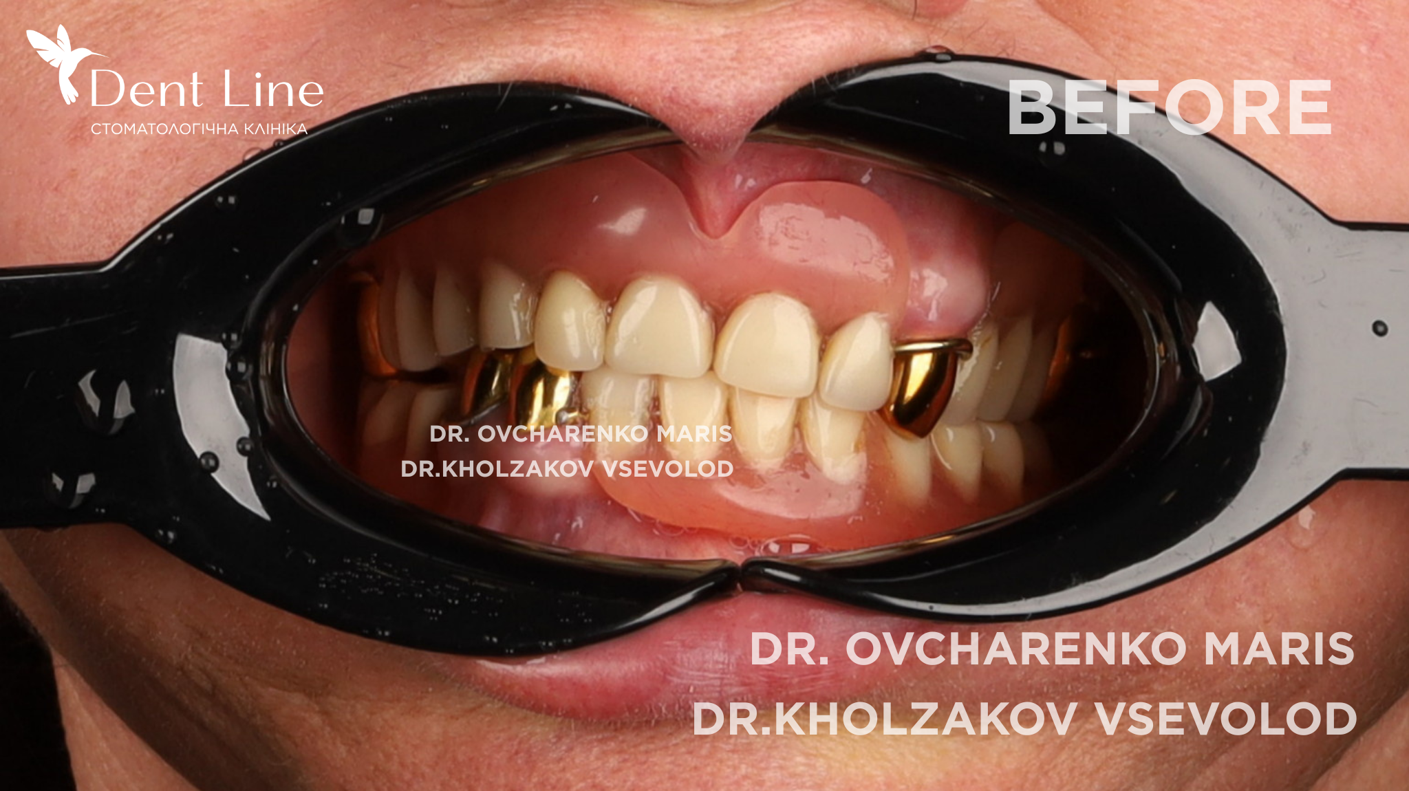 перепротезування зубів у києві